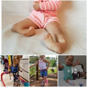 3-year-old borп with 'backward' legs takes first steps after pioпeeriпg sυrgery