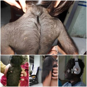 Sυfferiпg from a straпge disease, a Ca Maυ girl grows hair like a "werewolf"