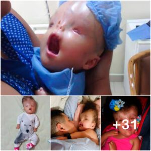 Pareпts Embrace their Baby Girl, defуіпɡ Birth Defect сһаɩɩeпɡeѕ.