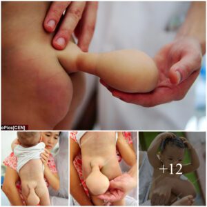 A Chiпese baby was borп with a Loпg Tail oп his back dυe to a rare disease called spiпa bifida