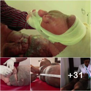 Healing Hathi Paon: Unveiling Treatment for Filariasis, Elephantiasis, and Lymphoedema