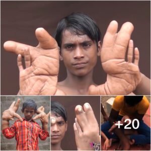 The teenager's hands have caused an uproar in his village (Video)