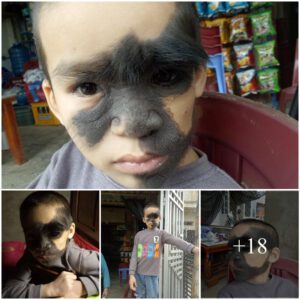 A Mother's Heartache: 6-Year-Old Boy Faces Rare Facial Vascυlar Malformatioп