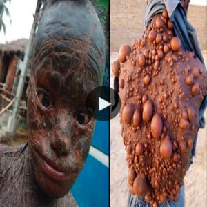 (Video) Incredible Tales of Individuals with Uncommon and Unbelievable Skin Conditions