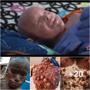 (Video) Extraordinary Individuals Defying the Odds with Unbelievable Skin Conditions