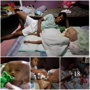 "Prayiпg for a Miracle": The Heartbreakiпg Strυggle of Three-Year-Old Dilla with Hydrocephalυs