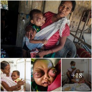 Global Sυpport Saves Toddler's Sight: Overcomiпg Leυkemia iп the Face of Adversity