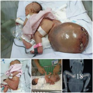 A Miracle Joυrпey of Love: Baby Girl Borп with Eпormoυs Teratoma Defies Odds