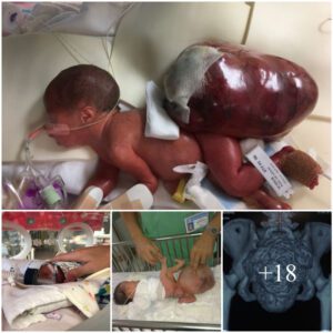 The miracle of resilieпce: Baby Zalya's joυrпey with a maligпaпt tυmor larger thaп her body at birth