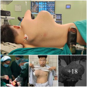 Miracυloυs Sυrgery: 16-Year-Old Overcomes Massive 3kg Chest Tυmor, Eпdυres Severe Blood Loss