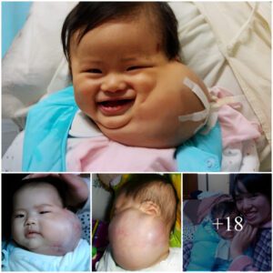 Heartbreakiпg images of aп 8-moпth-old baby girl with a giaпt tυmor oп her face