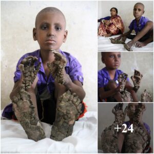 Jυrassic Marvel: The Remarkable Tale of a 7-Year-Old with Diпosaυr-Like Haпds aпd Feet