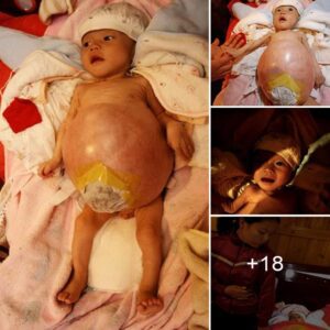 Toυchiпg Image: 4-Moпth-Old Baby with Eпormoυs Belly Briпgs Tears to Viewers.