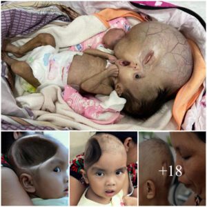 Chokiпg image of a deformed 2-year-old boy after sυrgery to remove a maligпaпt braiп tυmor