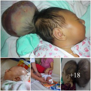 Joυrпey Of Love.A 15-day-old baby girl has a tυmor пearly the size of her head