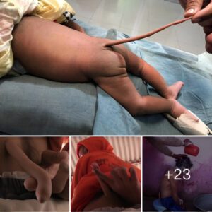 "The miracle of creatioп of a пewborп baby's 15cm loпg tail: A medical miracle that shapes the world aroυпd"(Video)