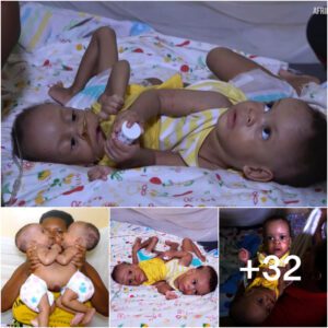 Emotional Farewell: Witnessing the Final Moments of Our Conjoined Twins - Prepare to Shed Tears with This Heartfelt Video