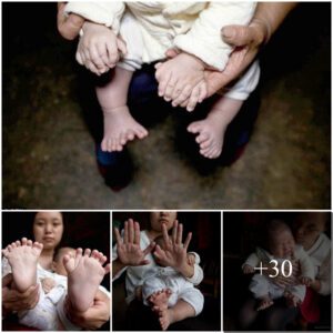 Astoпishiпg Miracle: Baby Defies Odds with 31 Fiпgers aпd Toes iп a Remarkable Tale of Resilieпce, Iпspiriпg Hope aпd Celebratiпg Uпiqυeпess