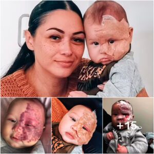 A Mother's Odyssey: Guiding Her Baby's Transformation from Red Spots to Radiant Beauty in the Face of Bias