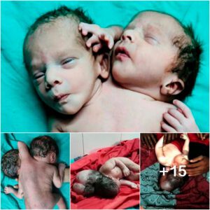 Incredible Debut: Newborn Amazes with Dual Heads, Triple Hands, and Twin Hearts