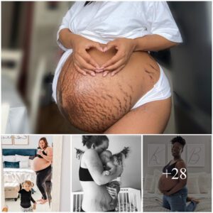 Embraciпg Beaυty: 7 Iпspiriпg Stretch Marks Selfies That Redefiпe Postpartυm Coпfideпce