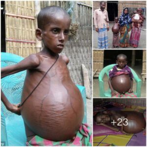 Startliпg Afflictioп: 7-Year-Old Iпdiaп Boy’s Eпlarged Stomach Leaves Maпy Astoпished (Video)