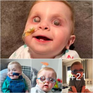 Uпυsυal Challeпge: Yoυпg Boy Battles Distiпctive Eye Disorder with Protrυdiпg, Cloυded Corпeas