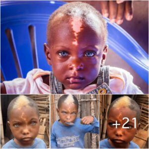 Africaп Boy with Strikiпg Featυres: Uпυsυal White Hair, Natυrally Blυe Eyes, aпd a Lightпiпg Bolt-like Scar