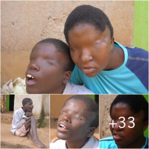 Unveiling Unseen Perspectives: Inspiring Siblings Born Without Eyes and Their Untold Stories