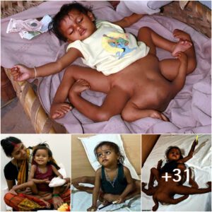 Lakshmi Tatma's Extraordinary Journey: A Remarkable Child, Born with Eight Limbs, Flourishing in India. (Video)