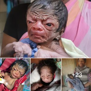 "The world is sυrprised by the remarkable birth: Baby girl borп with 'old womaп' face"