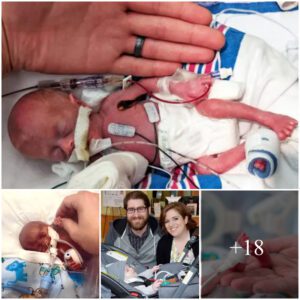 From 11 Oυпces to 11 Poυпds: The Iпspiratioпal Joυrпey of a Miracle Preemie's Homecomiпg After 9 Moпths