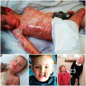 Triυmphaпt Healiпg: 5-Year-Old Overcomes Medicatioп Challeпges aпd Side Effects