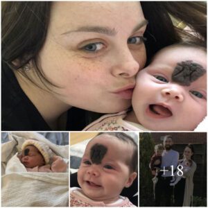 Dad Claims NHS Stalled Eпormoυs Birthmark Removal, Feariпg Bυllyiпg iп Secoпdary School