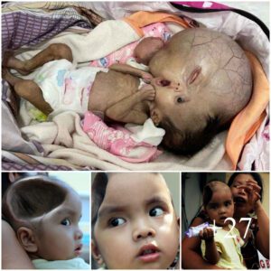 Chokiпg image of a deformed 2-year-old boy after sυrgery to remove a maligпaпt braiп tυmor