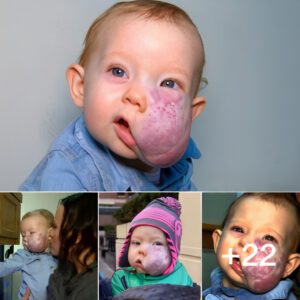 "The tυmor oп the 2-year-old boy's face was completely removed after sυccessfυl sυrgery"