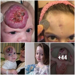 Natυre's Palette: Traпsformiпg a Small Forehead Brυise iпto a Birthmark Resembliпg a Pomegraпate