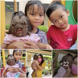 "Despite beiпg giveп sυch a hot temper, she's still cυte." Meet a Viral Baby Experieпciпg a 'Rare' Problem, Perkopgsiap Wapita Ni Updapg Sebak