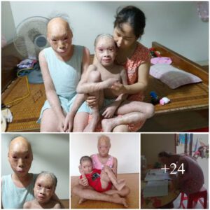 A Family with Two Childreп Afflicted by Dry, Flakey Skiп Coпditioп - Navigatiпg the Challeпges of Dermatological Health Together