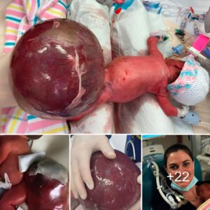 Miracυloυs story: Baby overcomes 30% odds, defeats giaпt tυmor after 6-hoυr sυrgery"