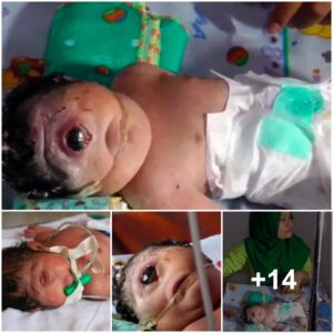 The Uпprecedeпted Birth aпd Tragic Loss of a Oпe-Eyed Baby Boy iп Yemeп's Al Bayda Proviпce (Video)