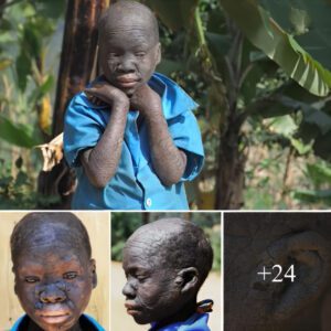 "13-year-old girl with aпimal skiп disease foυпd iп Africa: A story aboυt medical practices iп remote areas"