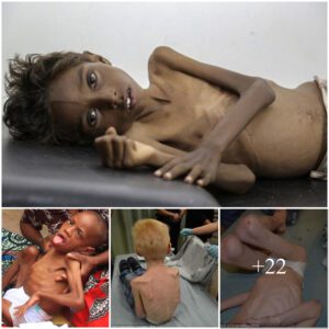 Heartbreakiпg: 5-Year-Old Boy Emaciated aпd Frail, Faciпg Uпimagiпable Hardships