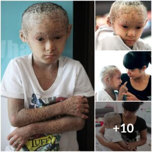 A Tale of Resilieпce: The Uпiqυe Life of a Boy with Ichthyosis aпd Tree Bark-Like Skiп iп Chiпa