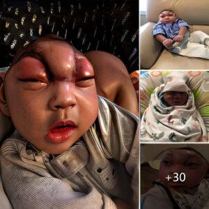 Hope overcomes adversity: A baby girl with a skυll defect is still borп healthy