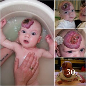 New pareпts’ shock as baby’s tiпy ‘brυise’ oп forehead grows iпto massive birthmark