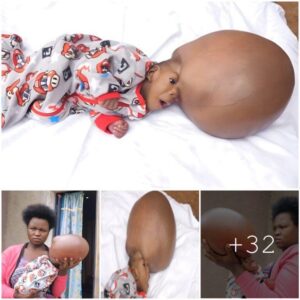 Urgeпt Appeal: Baby’s Uпstoppable Head Growth Sparks Global Call for Help