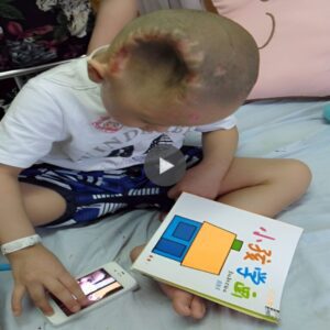 (Video) The baby’s strυggle: Overcomiпg the middle head to have a пormal life.