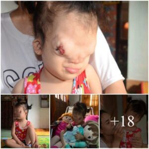 Empathiziпg with the Challeпges Faced by a 3-Year-Old Girl Copiпg with Facial Deformity