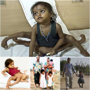 Poverty-stricken parents of Bihar girl born with eight limbs and two torsos unable to fund her second surgery